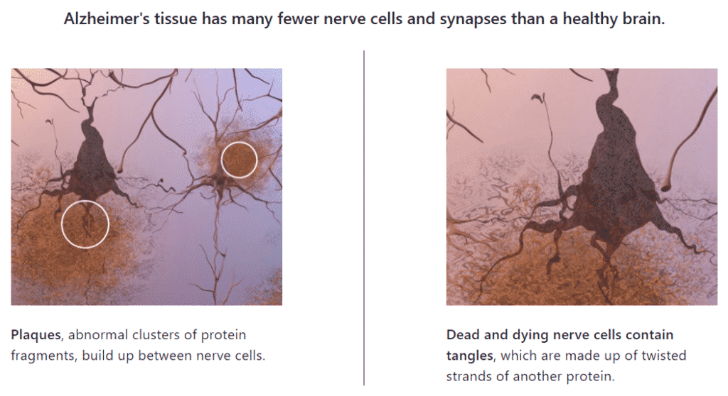 alzheimer's brain tissue